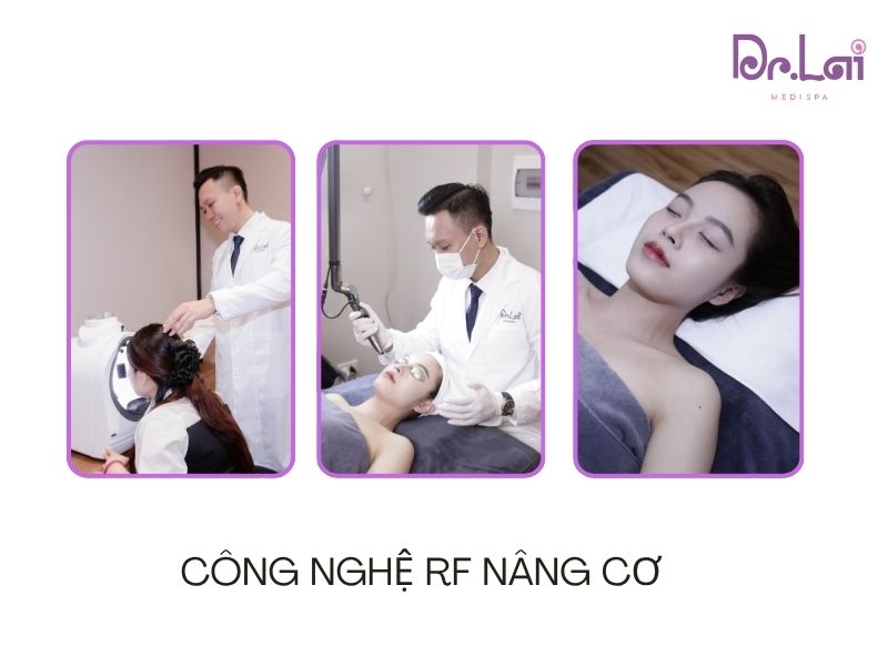 Công nghệ RF là gì? Nâng cơ mặt bằng sóng RF có tốt không?