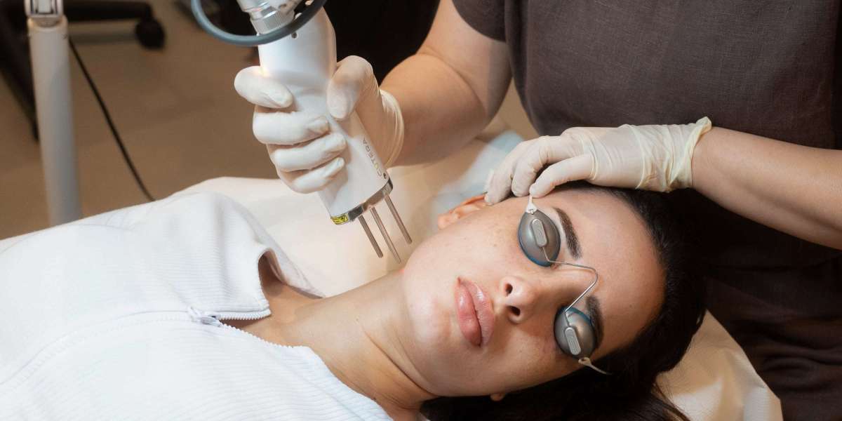 Picosure Laser Treatment for Stretch Marks: Does It Work?