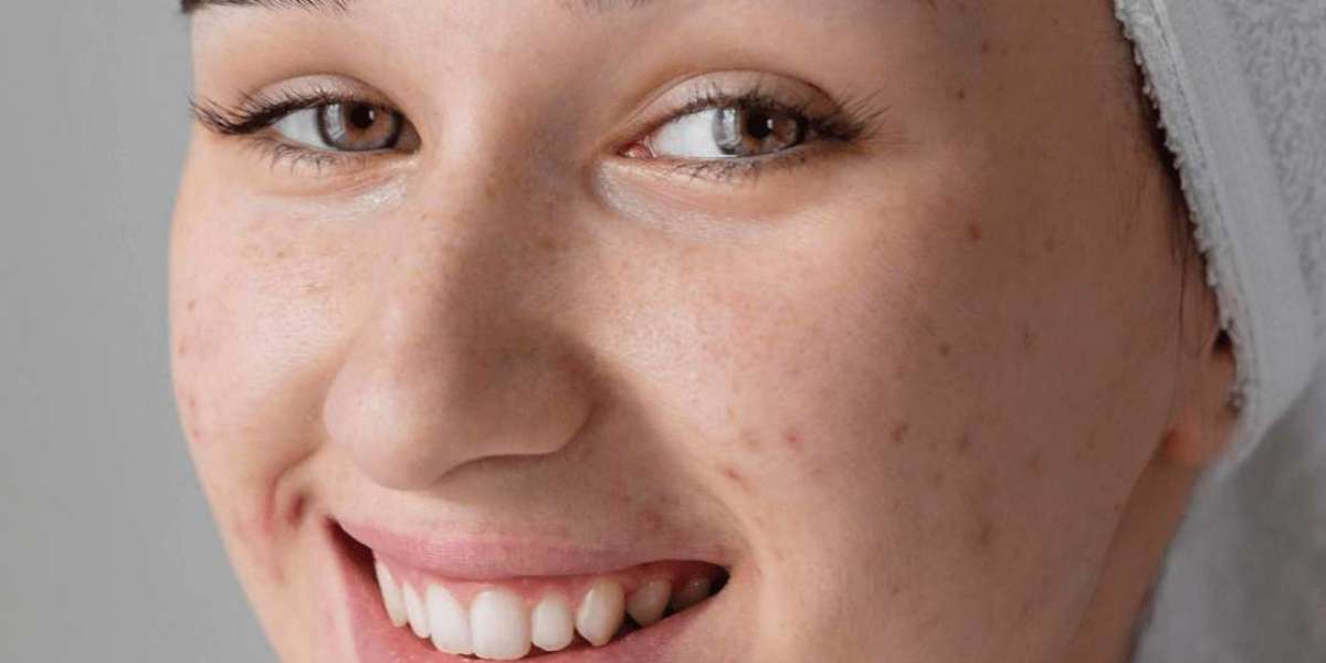 How Do Oral Medications Aid Pimples Treatment?