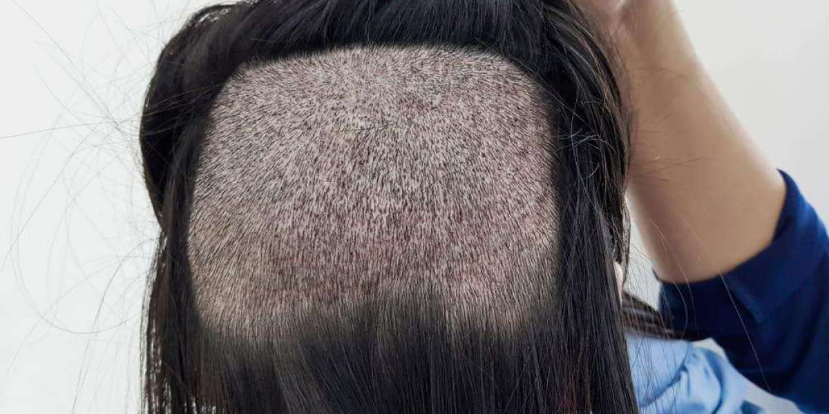 Who Is an Ideal Candidate for FUE Hair Transplant?