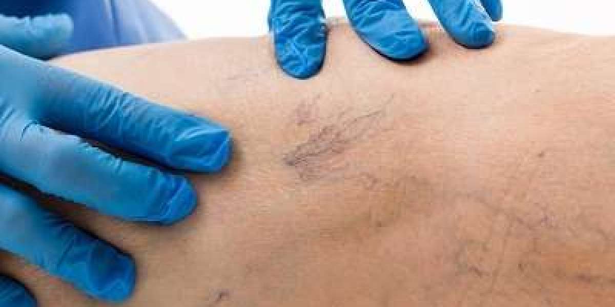 Is Sclerotherapy a Good Option for Older Adults?