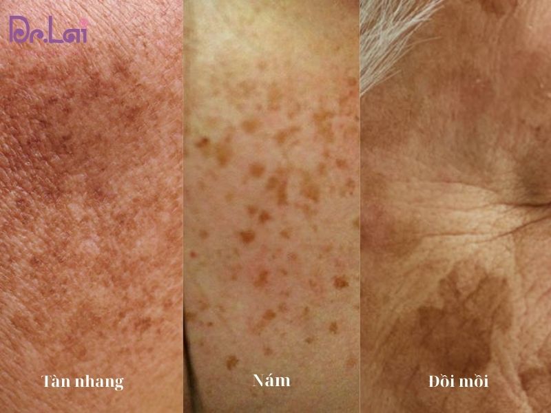 Trị nám tàn nhang dồi mồi bằng phương pháp Laser Yag hiện đại nhất