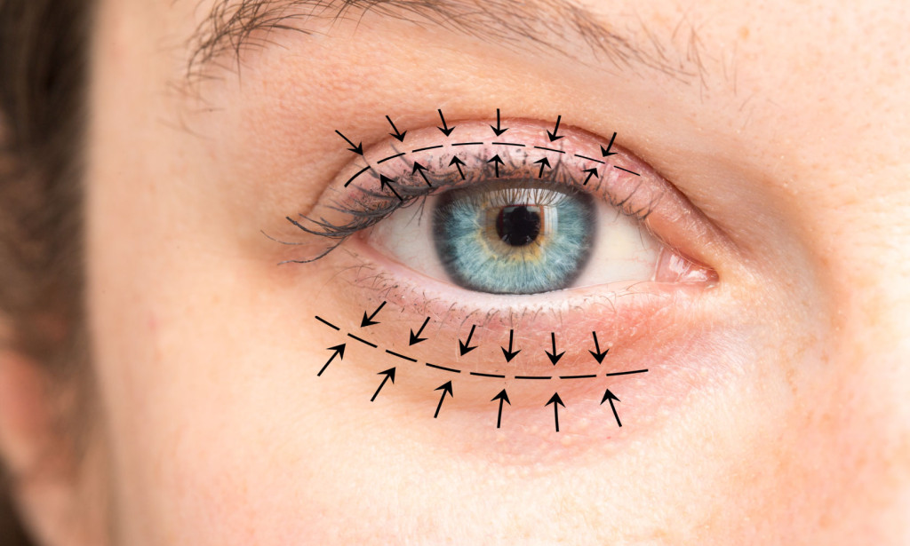 Blepharoplasty South Africa: Eyebrow Lift, Droopy Eyelid & Swollen Lower Eyelid Treatment in Cape Town