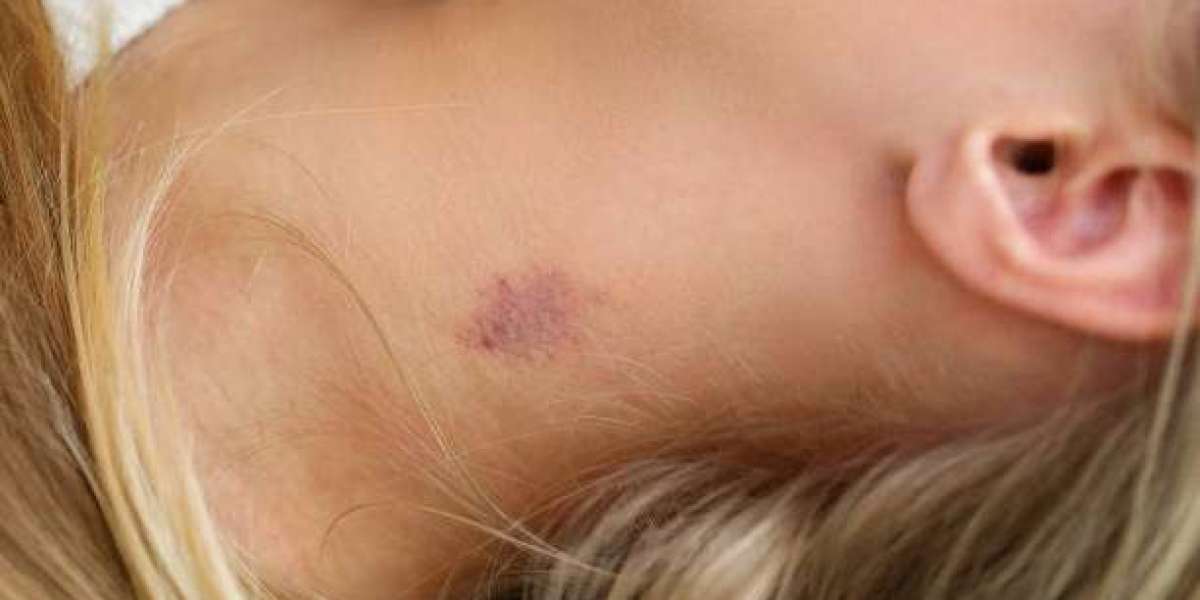 Does Birthmark Removal in Dubai Leave Scars?