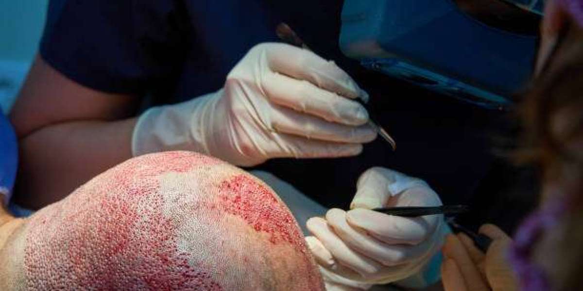 FUE Hair Transplant in Islamabad – The Ultimate Solution for Hair Loss
