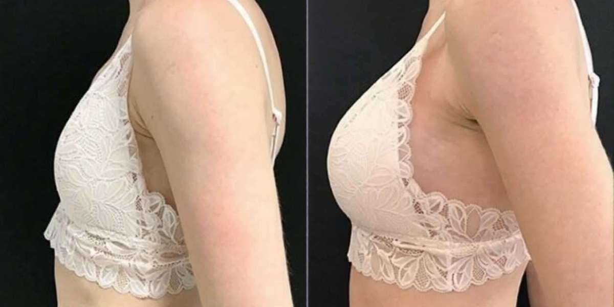 Elegant Breast Enlargement Injections in Islamabad