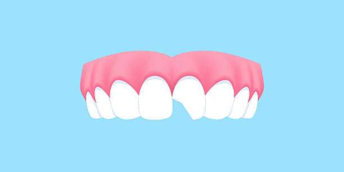 Restore Cracked Teeth: Tooth Fracture Treatment in Islamabad