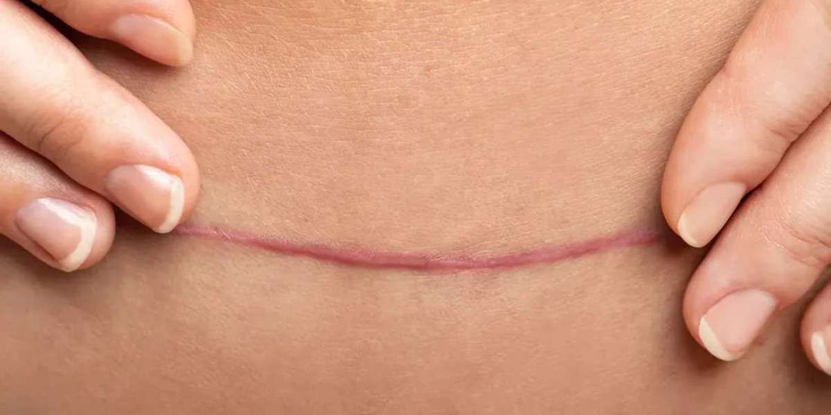 How Do Surgeons Determine Candidacy for Scar Revision?