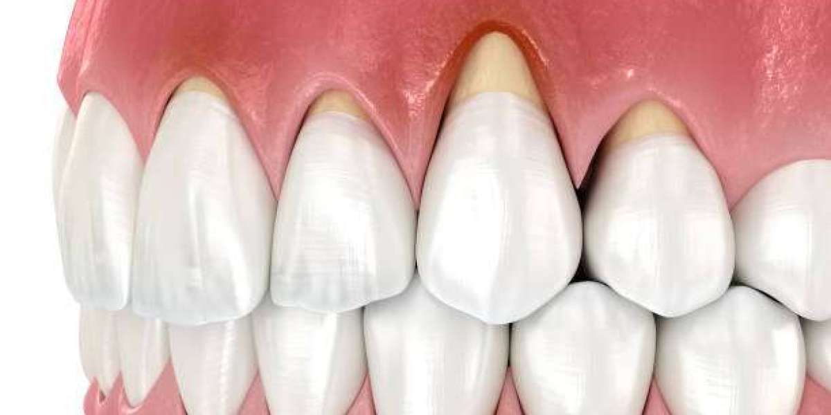 Restore Healthy Gums and Protect Your Smile Gum Grafting in Islamabad: