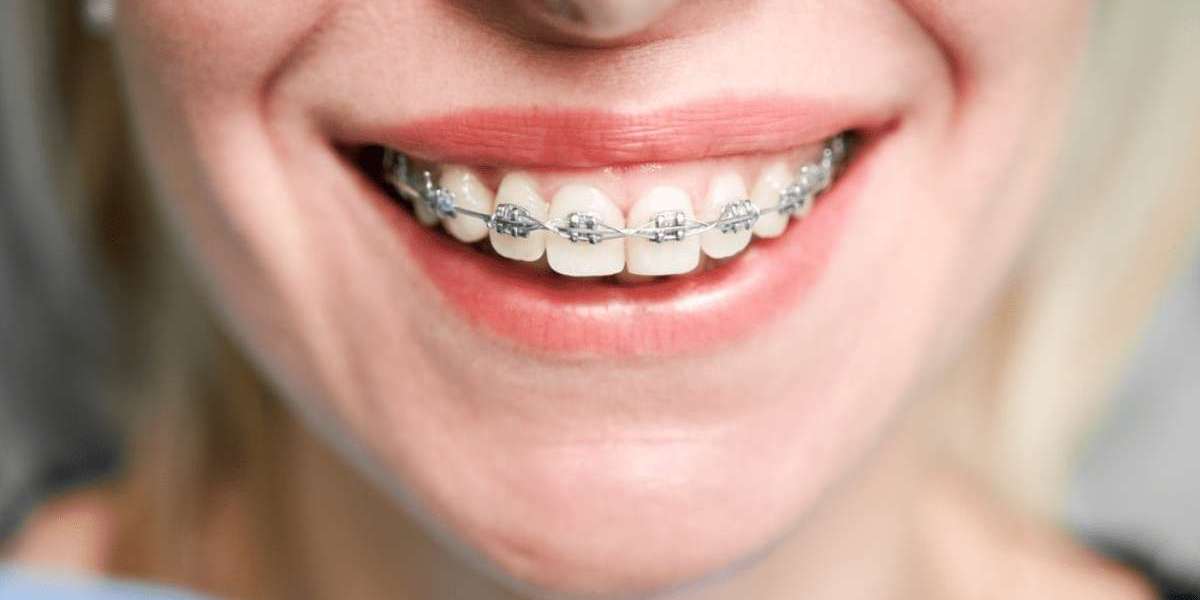 Teeth Braces Cost Guide: Budgeting for a Straighter Smile