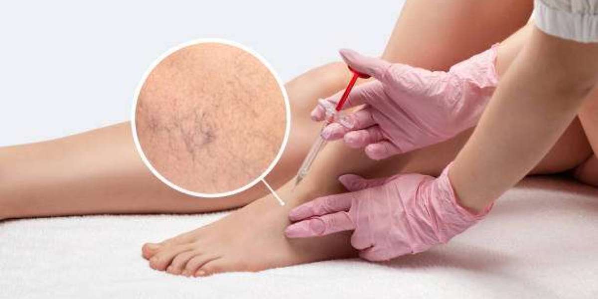 Expert Tips for Spider Veins Treatment in Dubai Success 2026