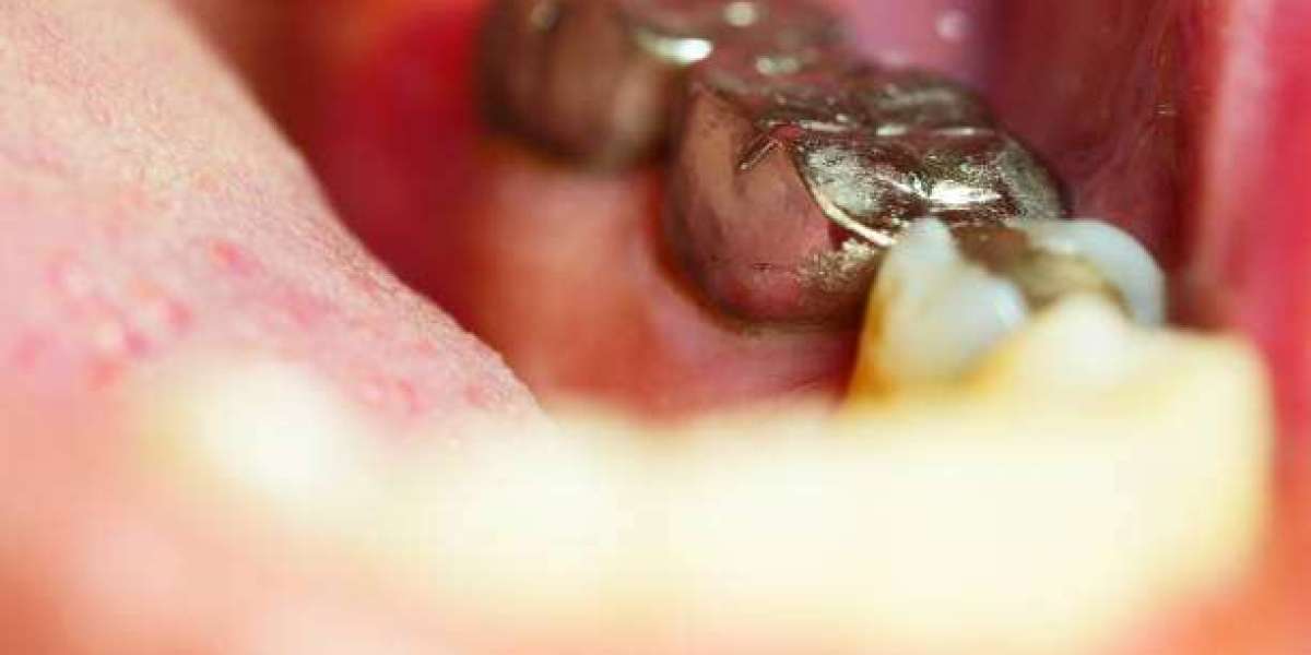 Professional Dental Fillings in Islamabad for a Healthy Smile